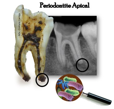 Imagem interna de uma dente com Periodontite Apical. .